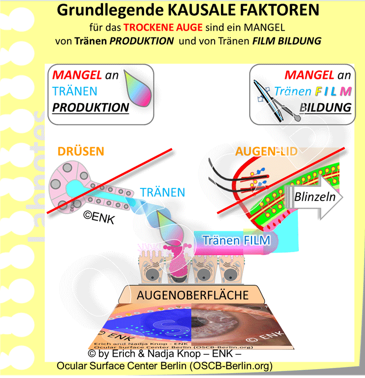 Die beiden grundlegenden Voraussetzungen für die Gesundheit der Augenoberfläche und für das intakte Sehen sind die Bildung von Tränenflüssigkeit und die Herstellung eines stabilen Tränenfilms daraus. Entsprechend sind die beiden wichtigsten Faktoren für die Entstehung eines Trockenen Auges ein Mangel an Tränenflüssigkeit und/ oder ein Problem bei der Herstellung eines ausreichend stabilen Films daraus.