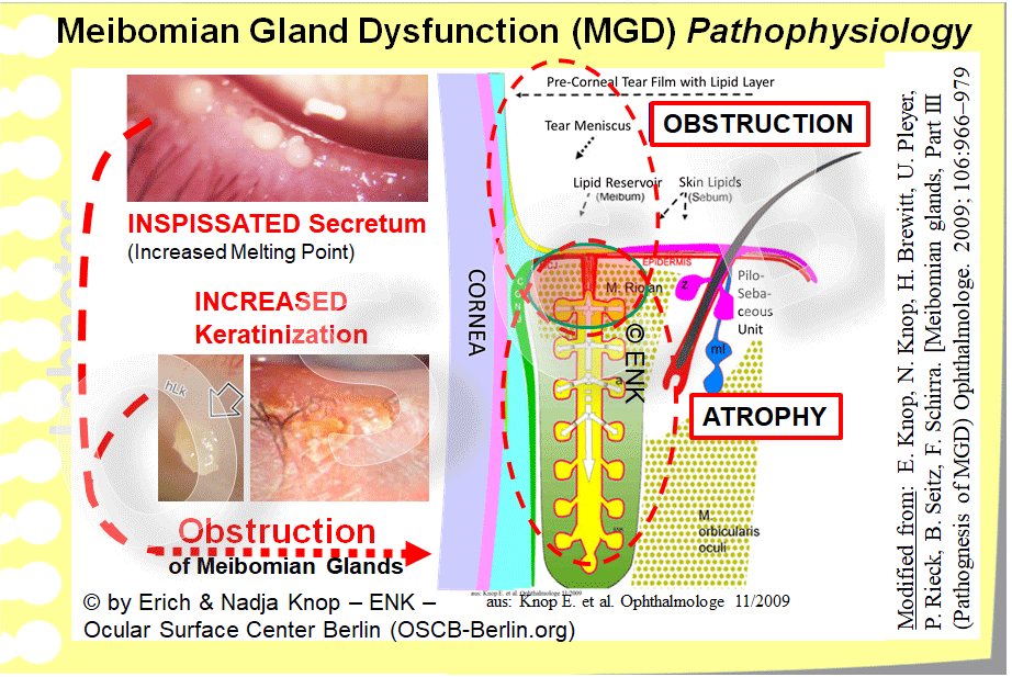 In a more focused an clinically oriented diagram, the two main PATHOGENETIC FACTORS that contribute to Meibomian Gland Dysfunction are shown together with the main CONSEQUENCES. Inspissated Meibomian Lipids , due to the occurrence of altered lipid species with increased melting point, and Hyperkeratinization of the Epithelium on the lid margin and inside the glands, can, together or alone, lead to obstruction of the Glands. The important downstream CONCEQUENCES are a (1) Lipid Deficiency on the lid margin and Tear Film with Tear Film Instability and Evaporative Dry Eye Disease. Also (2) an unnoticed pressure atrophy of the gland tissue inside the eye lids can occur due to the continuing production of oil. This leads to dilatation of the ducts and to atrophic destruction of the Secretory Meibocytes in the acini.