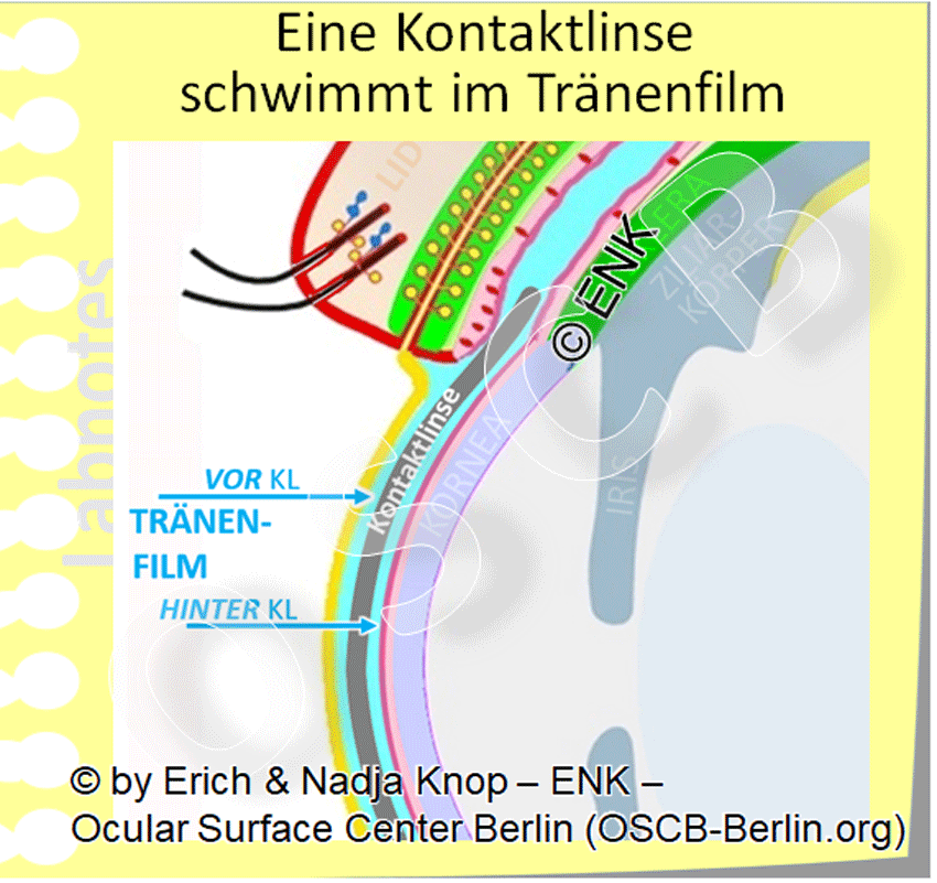 D-UEBERBLICK über  KONTAKTLINSEN — Ocular Surface Center Berlin