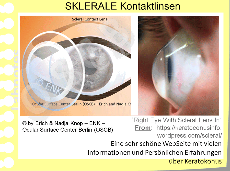 D-BLICK auf  KONTAKTLINSEN — Ocular Surface Center Berlin