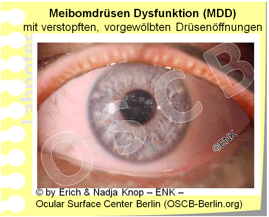 D-BLICK auf ... MDD — Ocular Surface Center Berlin