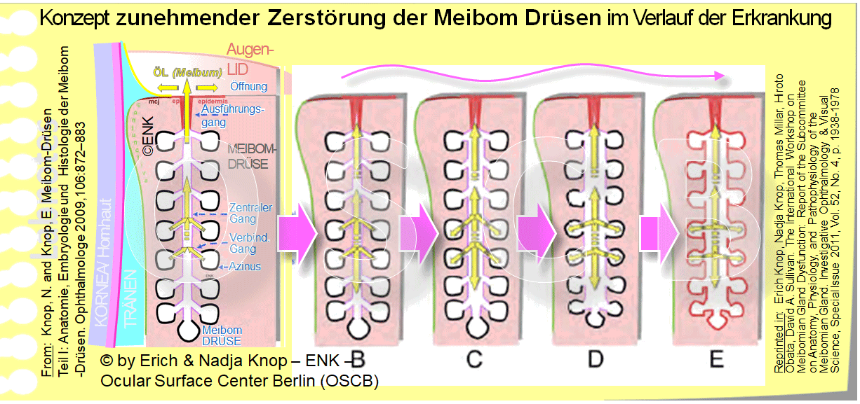Bei einem Verschluss der Drüsenöffnung auf dem hinteren Lidrand kommt es, durch die ständige Produktion von weiterem öligem Sekret in den Drüsenendstücken , zur nachfolgenden Ansammlung von Sekret in der Drüse und dadurch zu einer Erhöhung des Drucks in der Drüse und nachfolgender Schädigung des Drüsengewebes bis zur Zerstörung.