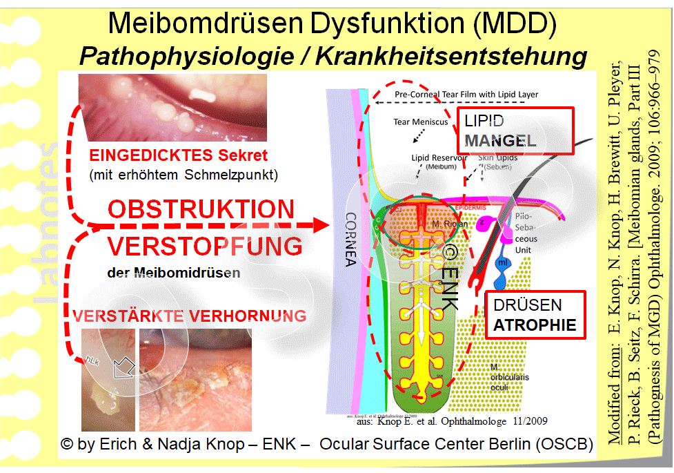 Die beiden PATHOGENETISCHEN HAUPTFAKTOREN der MDD sind hier gezeigt zusammen mit ihren Konsequenzen. EINGEDICKTES SEKRET mit erhöhtem Schmelzpunkt , das durch das Auftreten von Lipid-Veränderungen entsteht, sowie eine HYPER-KERATINISIERUNG des Epithels in den Drüsengängenund auf dem Lidrand führen zur VERSTOPFUNG der Meibomdrüsen. Wesentliche KONSEQUENZEN der Verstopfung sind (1) LIPIDMANGEL auf dem Lidrand und Tränenfilm , der zum Tränenmangel und damit zum Trockenen Auge führt - sowie (2) ein ERHÖHTER DRUCK in den Meibomdrüsen durch Sekretaufstau. Dieser führt zu einer Erweiterung des Gangsystems und zur Druckschädigung der Lipid bildenden Sekretorischen Zellen in den rundlichen Endstücken ... und zu einem nachfolgenden Untergang von funktionellem Drüsengewebe.