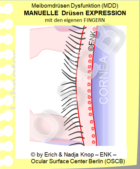 Blick von oben auf ein Unterlid bei AUSPRESSUNG der Meibomdrüsen . Bei verstopften Meibomdrüsen kann es sinnvoll ein, zusätzlich zu einer sanften Lidmasssage, das Augenlid zwischen 2 Fingern vorsichtig auszupressen. Dies ist am einfachsten nach einer feuchten Wärmung, wenn verhärtetes Sekret in den Drüsen wieder flüssiger geworden ist. Eine Reinigung des Lidrandes durch ´ Lidrandhygiene ´ sollte sich anschliessen (folgende Abbildung).