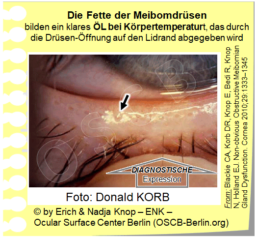 Der leichte Druck mit dem Finger von aussen auf den Lidrand(DIAGNOSTISCHE EXPRESSION (Offener Pfeil) ist der einfachste und sicherste Test für die intakte FUNKTION der Meibomdrüsen. Eine gesunde Drüse gibt dann ein kleines Tröpfchen dünnflüssiges, klares Öl ab, das eine kleine Pfütze um die Drüsenöffnung bildet (kleiner Pfeil)