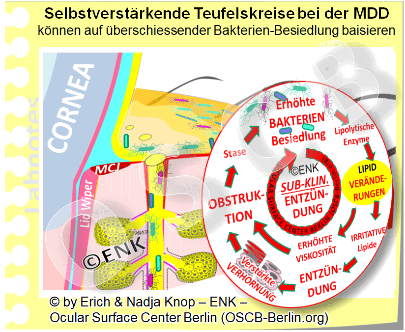 ÜBERSCHIESSENDES BAKTERIENWACHSTUM (Bakterielle Kolonisierung) des Lidrandes und vermutlich auch der Meibomdrüsen erscheint als wichtiger pathogenetischer Faktor bei der MDD . Sie ruft durch die Produktion Lipid-zersetzender Bakterienenzyme eine Veränderung der normalen Meibom Lipide hervor, was zu Gewebe-reizenden Lipiden führt. Diese können eine chronische Sub-klinische Entzündung auslösen, die im Weiteren zu einer verstärkte Verhornung des Epithels führen kann. Verhornung ist, wie beschrieben, ein bedeutender Ko-Faktor für die Verstopfung der Meibomdrüsen, die zu einer Stase und Ansammlung des Sekretes in der Drüse führt. Dies wiederum befördert typischerweise das Wachstum von Bakterien . Die beschriebenen Zusammenhänge stellen damit insgesamt einen selbstverstärkenden Teufelskreis dar, der eine chronische Erkrankung mit Selbstverschlimmerung aufrecht erhalten kann ... wenn dieses nicht durch eine Therapie ( siehe dazu im Text ) unterbrochen wird.