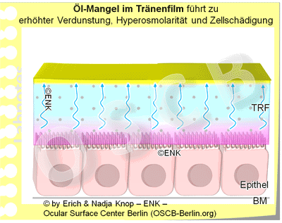 Interessanterweise ist die Bildung der Ölschicht des Tränenfilms von grösserer Bedeutung als die Bildung von Tränenwasser, da bei Öl-Mangel auch reichliches Tränenwasser schnell verdunstet. Es entstehen dann Lücken im Tränenfilm und die empfindlichen Zellen der Augenoberfläche werden geschädigt.