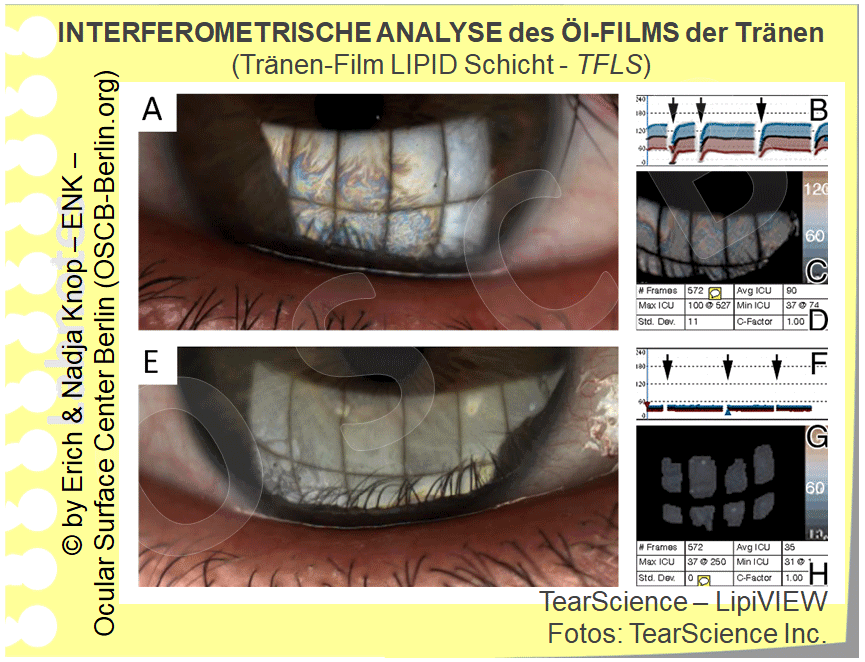 OSCB-Berlin.org_INTERFEROMETRISCHE-ANALYSIE-des-Öl-FILM-der-Tränen-(Tränen-Film-LIPID-Schicht---TFLS)_Tear-Science-LIPIVIEW_.gif