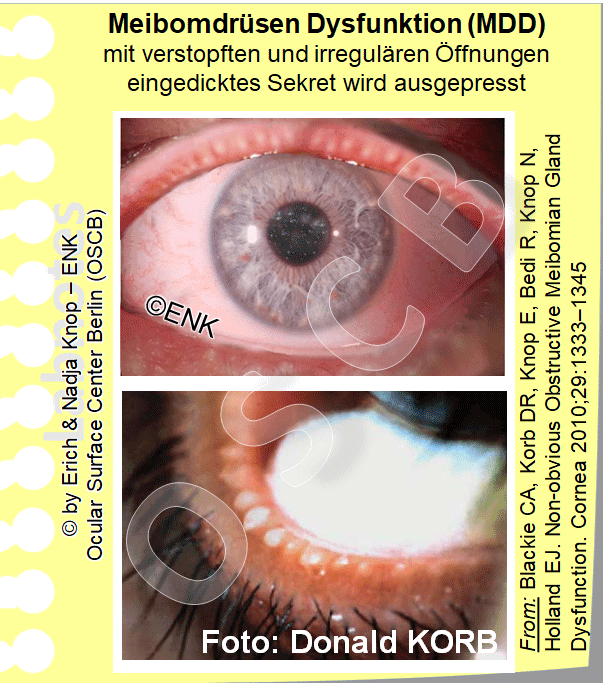 Eine STÖRUNG der MEIBOMDRÜSEN , die M eibom D rüsen D ysfuktion ( MDD ) ist die häufigste primäre Ursache für die Entwicklung eines Trockenen Auges . Dies ist typischerweise eine Drüsenverstopfung mit eingedicktem Sekret. Sie führt zu einem Mangel von Meibomöl auf dem Tränenfilm und damit zu erhöhter Verdunstung der wässrigen Tränen und einem nachfolgenden Trockenen Auge.