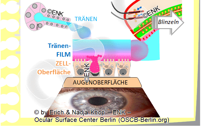 GIF-Animation-GRUNDLEGENDE-KAUSALE-FAKTOREN-für-das-TROCKENE-AUGE_DEUTSCH---Focus-PLATTENEPITHEL-METAPLASIE_VOLLpix-26-1,5.gif