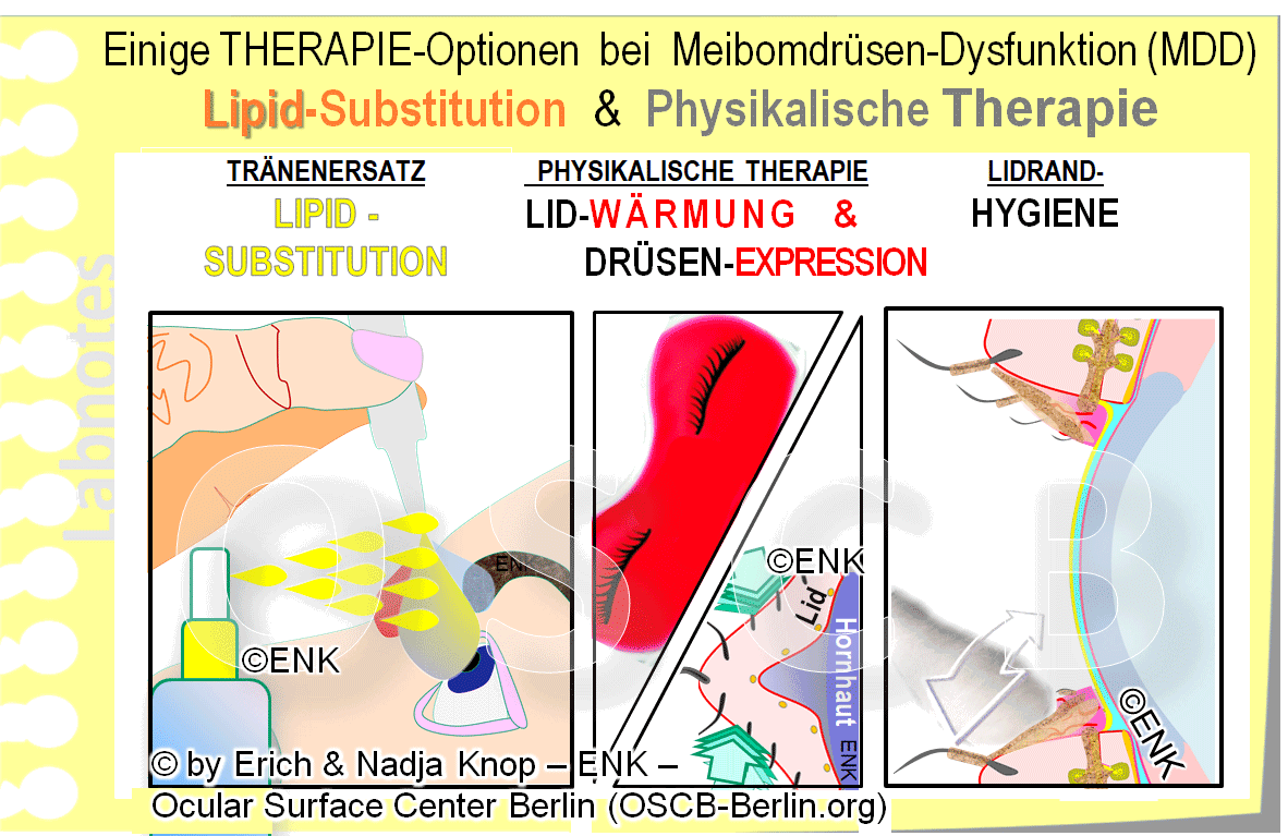 OSCB-Berlin.org_Einige-THERAPIE-Optionen--bei--Meibomdrüsen-Dysfunktion-(MDD)_Lipid-Substitution-+-Physikalische-Therapie.gif