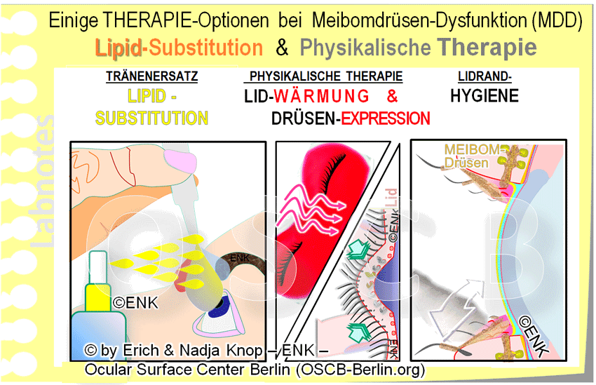 OSCB-Berlin.org_Einige-THERAPIE-Optionen--bei--Meibomdrüsen-Dysfunktion-(MDD)_Lipid-Substitution-+-Physikalische-Therapie.gif