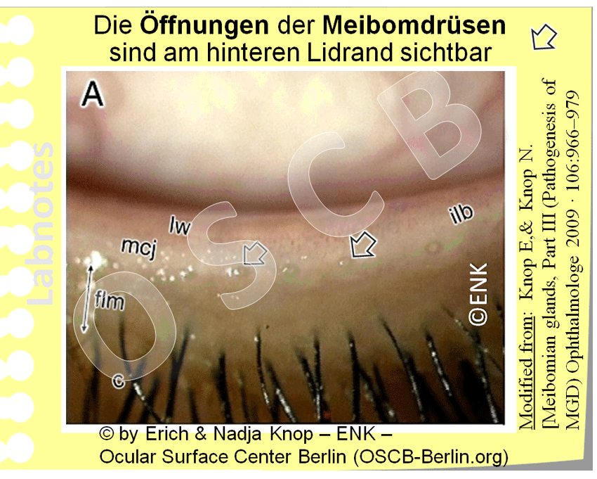 OSCB-Berlin.org_Die-Öffnungen-der-Meibomdrüsen-sind-am-hinteren-Lidrand-sichtbar.gif