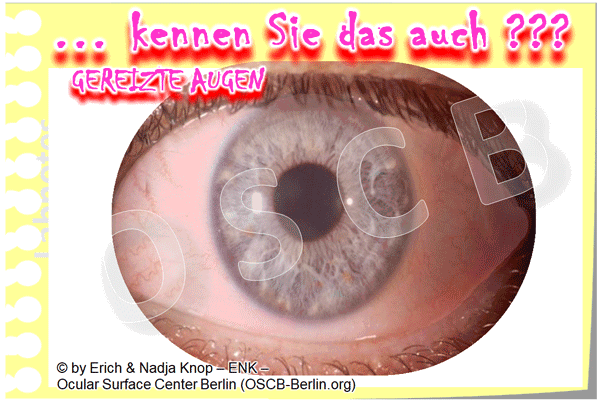 Animation-TROCKENES-AUGE,-DRY-EYE-SYMPTOME_600pix-23-2,5-+-UNSCHARF.gif