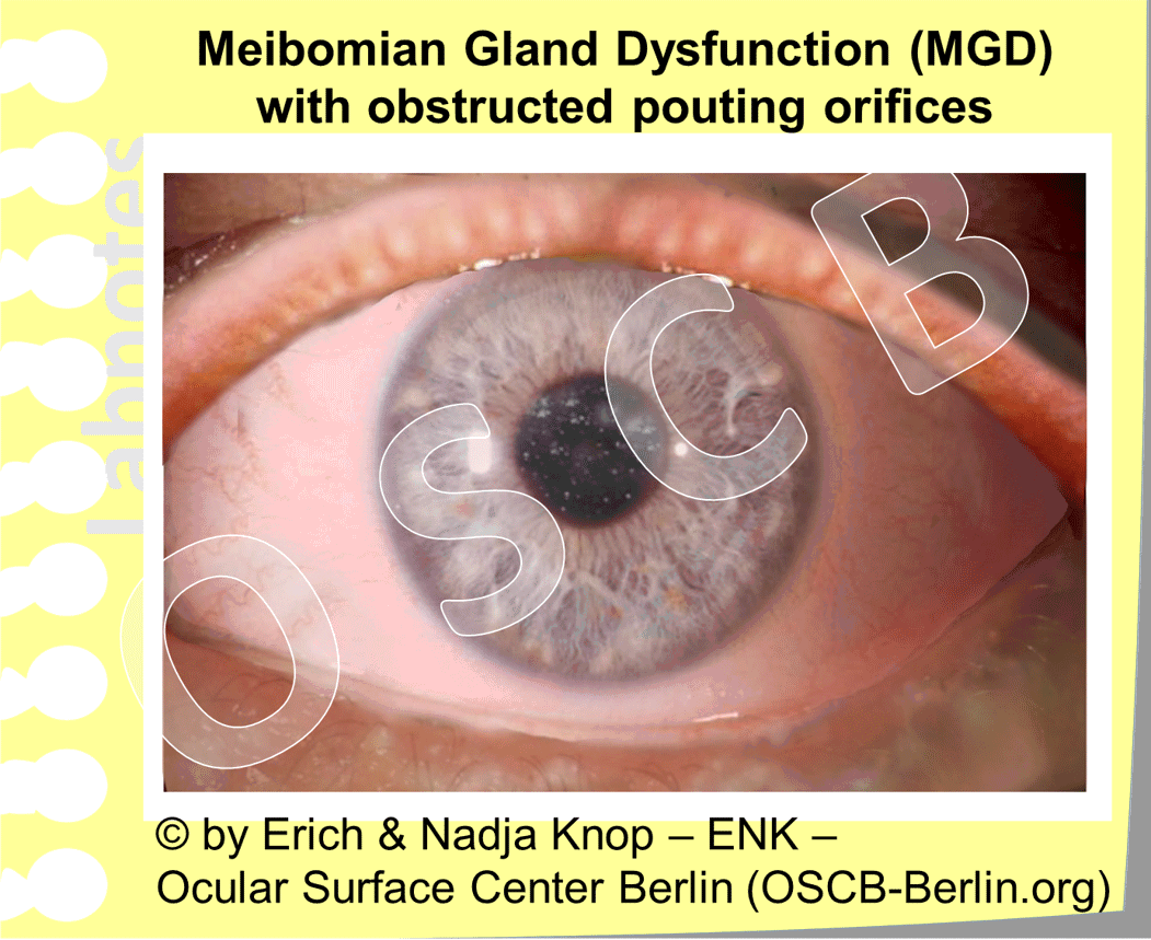 Normal Meibomian Gland Blepharitis And Meibomian Gland Dysfunction normal-meibomian-gland-blepharitis-and-meibomian-gland-dysfunction