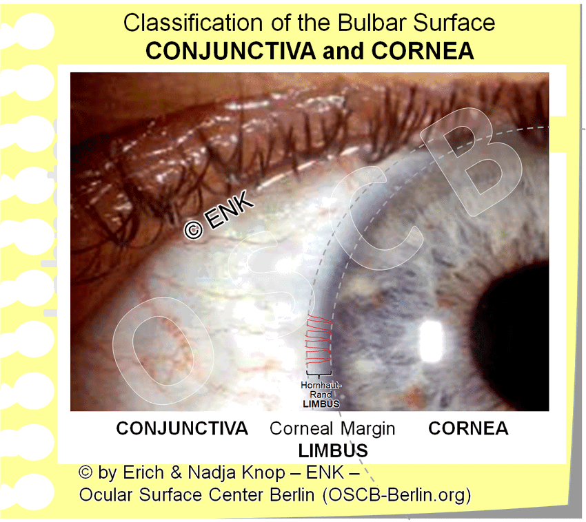 The CORNEA — Ocular Surface Center Berlin