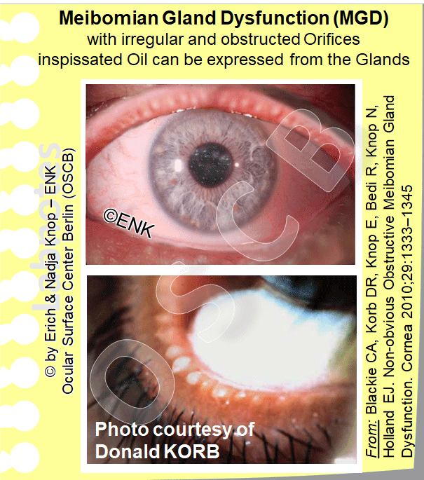 OSCB-Berlin.org_(c)ENK_Trockenes-Auge,-Dry-Eye-Disease_Meibomian-Gland-Dysfunction-(MGD)-with-irregular-and-obstructed-Orifices-inspissated-Oil-can-be-expressed-from-the-Glands.gif