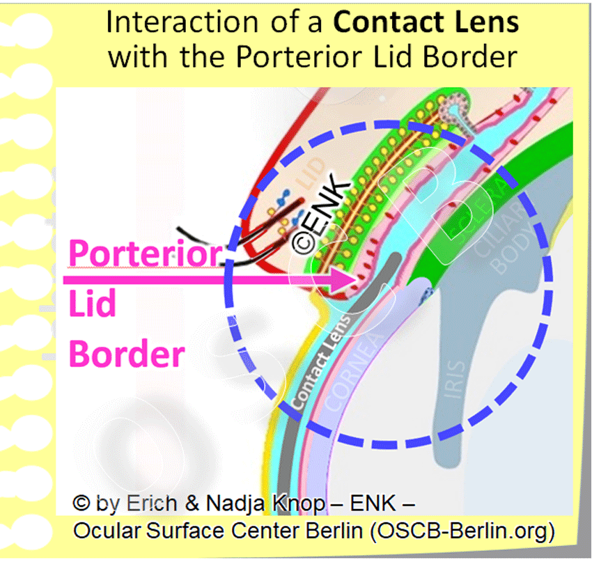 Contact Lens interactions with the Ocular Surface – A crtitical issue is the interaction between contact lens margin, posterior lid border and the corneal rim (limbus). Also, the contact lens margin typically exerts friction onto the bulbar conjunctiva.