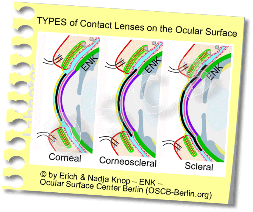 DEEPER INSIGHT into Contact Lenses HISTORY TYPES SCHEDULES