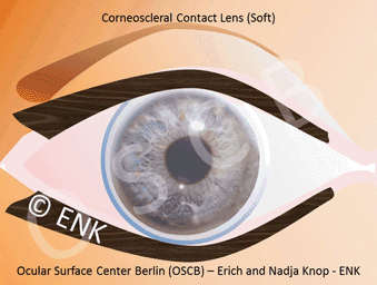 OSCB-GIF_KL Weich_OSCB+TEXT_LIDER (FRONTAL) ANIMATION BLINZELN_ + KONTAKTLINSE WEICHE Corneoscleral FESTER (80-72) 18-2 GIF 2x8Bit_.gif