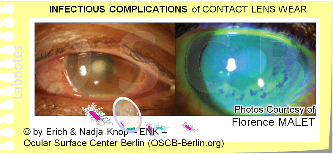 OSCB-Berlin.org_INFECTIOUS-COMPLICATIONS-of-CONTACT-LENS-WEAR.gif