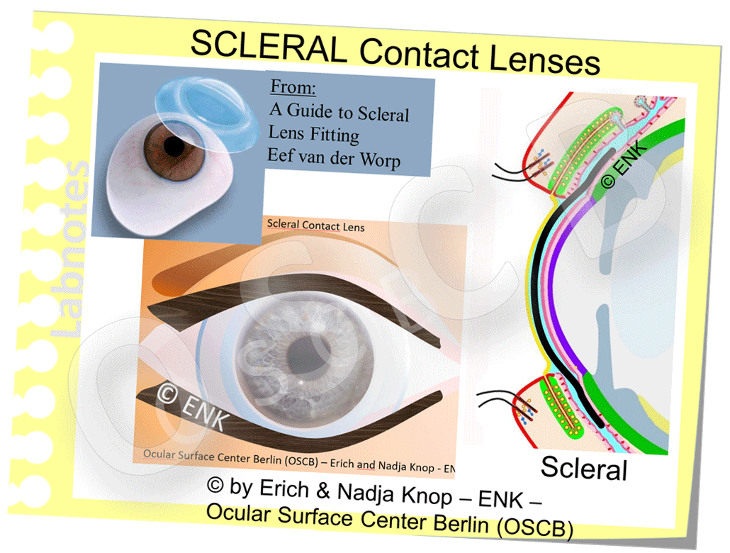 DEEPER INSIGHT into Contact Lenses HISTORY TYPES SCHEDULES FITTING — Ocular Surface