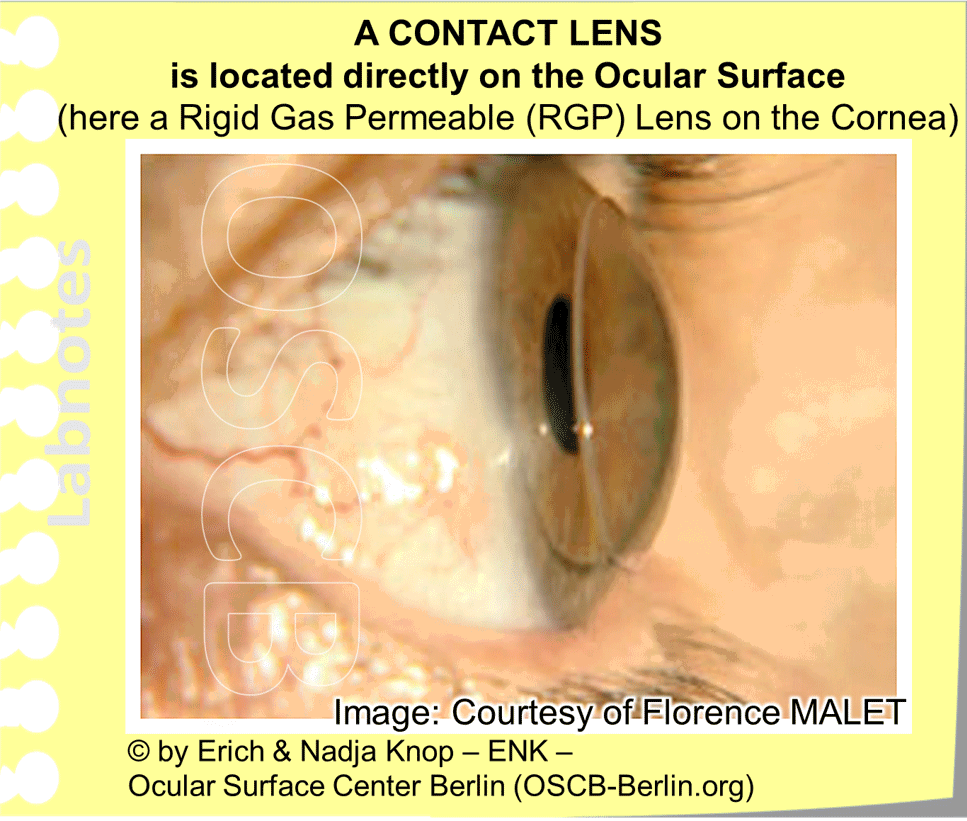 DEEPER INSIGHT into ... Contact Lenses - HISTORY - TYPES - SCHEDULES -  FITTING — Ocular Surface Center Berlin