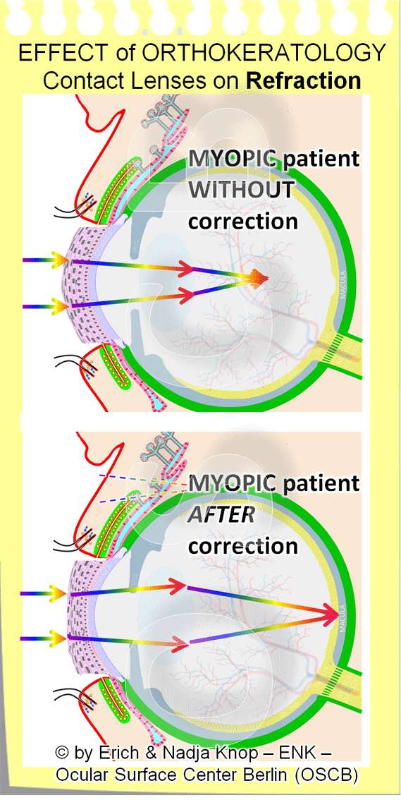 The effect of correction of the outer corneal shape by an Orthokeratology (OK) Contact Lens is shown here for a myopic patient. The flattening of the corneal surface ( lower image ) leads to de-focusing of the light and the focus point in the eye is therefore shifted to the back onto the retina. This leads to a sharp image in contrast to the uncorrected situation ( upper image ) where the focus point is in front of the retina which results in an unfocused image ... as every myopic patient knows ;-)