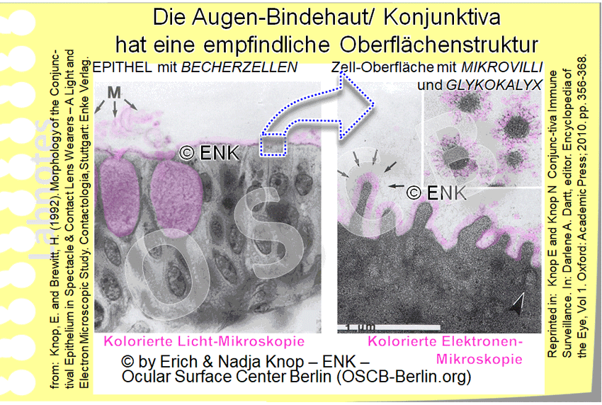 Die Oberfläche einer Zelle der Augenbindehaut (Konjunktiva) an der Grenze zum Tränenfilm zeigt in sehr starker elektronenmikroskopischer Vergrösserung zarte Fingerartige Fortsätze (Mikrovilli, MV) und Falten (Mikroplicae, MP). Fest in der Zellmembran verankert ist ein dichter Saum vom relativ langen faserigen Molekülen, wie auch im Querschnitt durch Mikrovilli zu erkennen ist (oben rechts). Diese bestehen aus Zuckerartigen Substanzen und werden daher auch insgesamt als Glykokalyx (Zuckermantel) bezeichnet. Die Glykokalyxmoleküle haben eine starke Bindungsfähigkeit für Wasser und sind darum eine wichtige Voraussetzung dafür, dass die Augenoberfläche das Wasser der Tränenflüssigkeit binden kann und damit ´benetzbar´ ist.