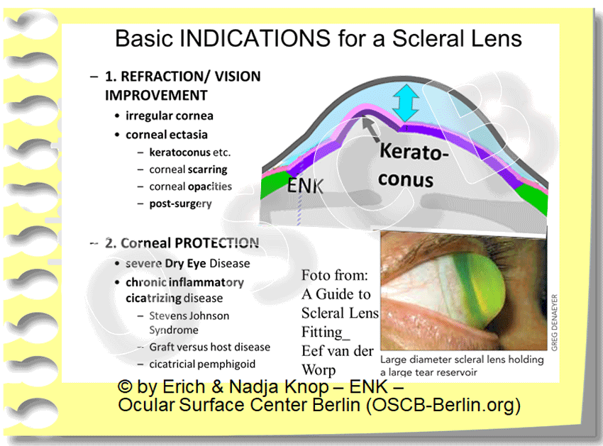 OVERVIEW of Contact Lenses — Ocular Surface Center Berlin