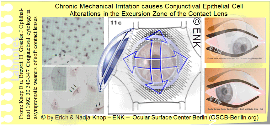 OSCB-Berlin.org_(c)ENK_Trockenes-Auge,-Dry-Eye-Disease,-Contact-Lens,-Kontaktlinse_Chronic-Mechanical-Irritation-causes-Conjunctival-Epithelial-Cell-Alterations-in-the-Excursion-Zone-of-the-Contact-Lens.gif