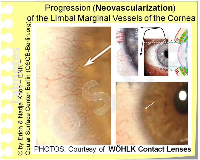 DEEPER INSIGHT into Contact Lenses HISTORY TYPES SCHEDULES