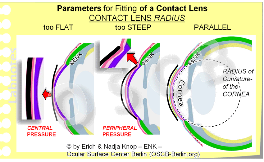 DEEPER INSIGHT into Contact Lenses HISTORY TYPES SCHEDULES FITTING — Ocular Surface