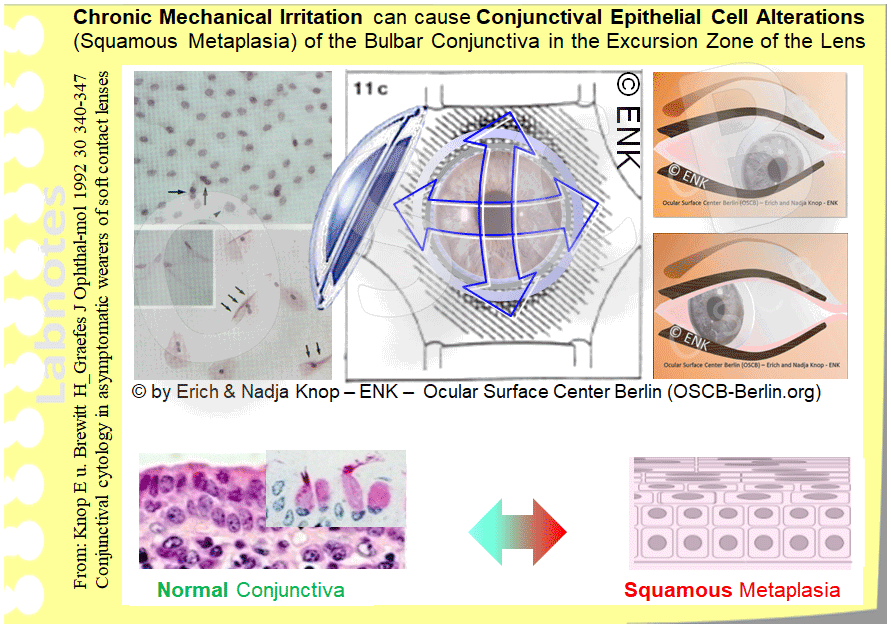 OSCB-Berlin.org_(c)ENK_Trockenes-Auge,-Dry-Eye-Disease,-Contact-Lens,-Kontaktlinse_Chronic-Mechanical-Irritation-by-Contact-Lenses-can-cause-Bulbar-Conjunctival-Epithelial-Cell-Alterations-(Squamous-Metaplasia).gif