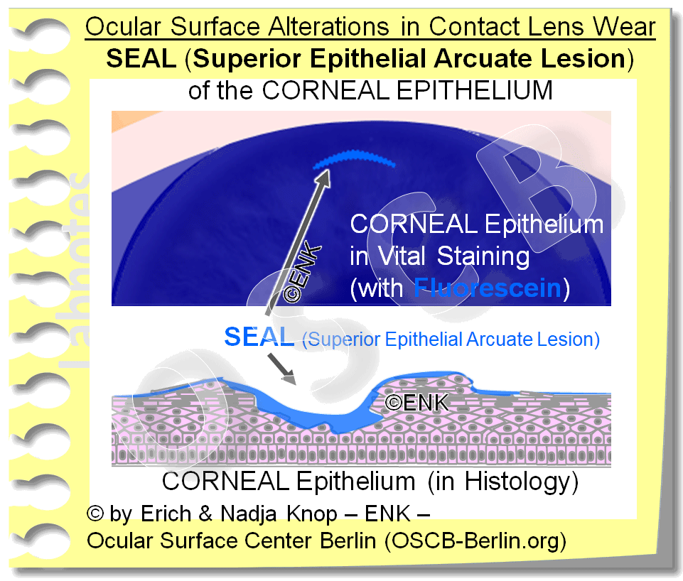 DEEPER INSIGHT into Contact Lenses HISTORY TYPES SCHEDULES