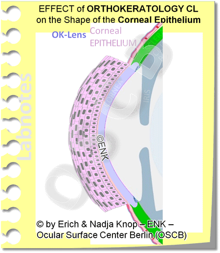 GIF-ANIMATION_ORTHOKERATOLOGY-Contact-Lens_450-27-1_.gif