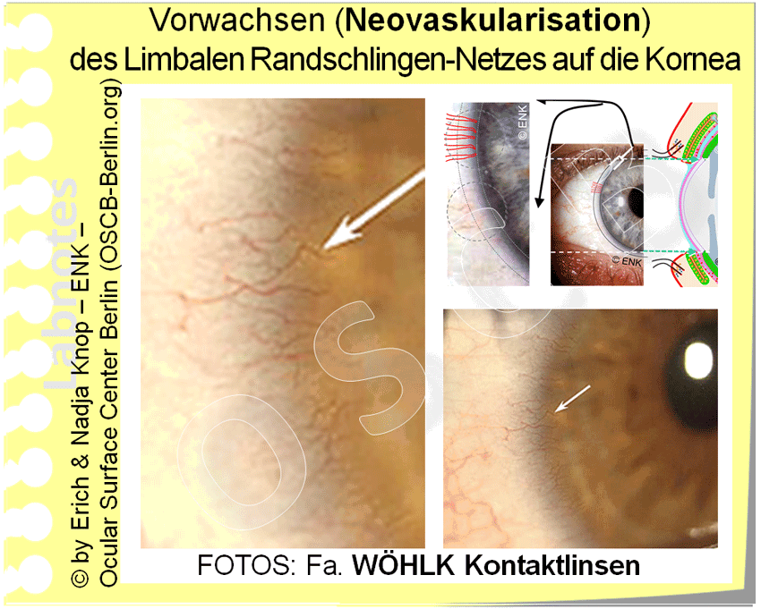 D-UEBERBLICK über  KONTAKTLINSEN — Ocular Surface Center Berlin