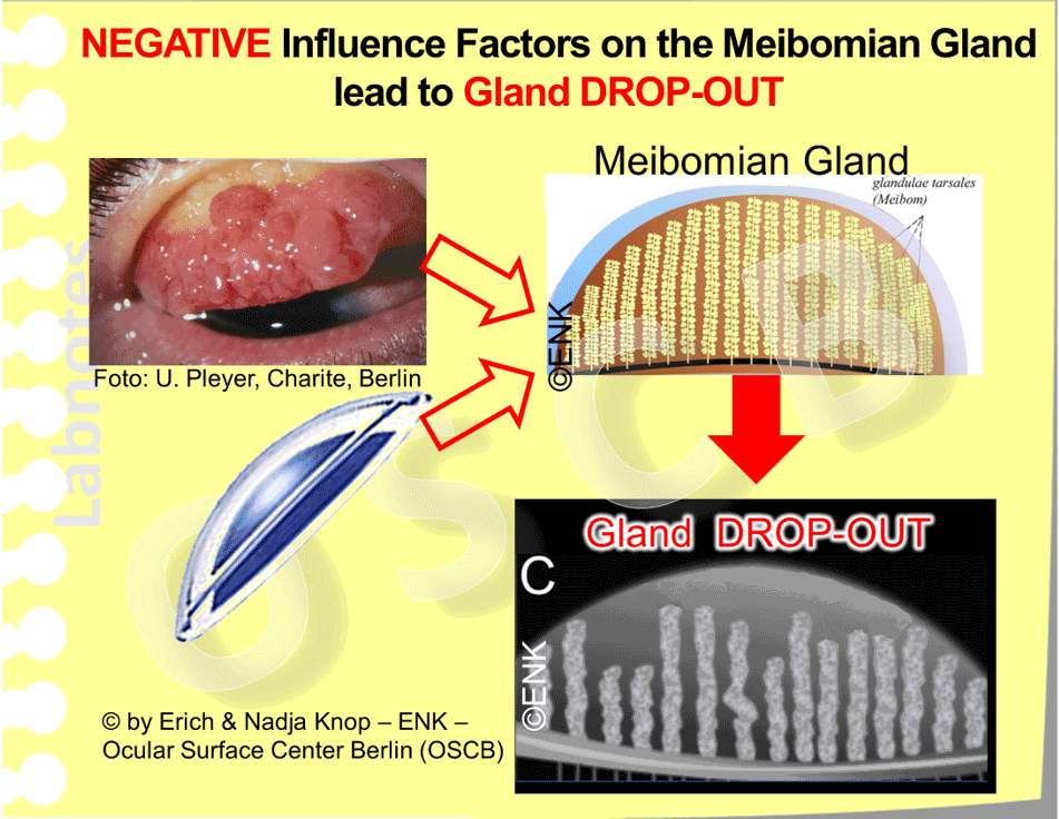 Negative Influence factors such as Contact Lenses and Inflammatory Conjunctival Disease (Allergic Conjunctivitis) lead to a destruction of the Meibomian Glands. This is detectable as visible Drop-Out of Gland Tissue in Meibography (bottom right, schematic representation) that constitute MGD, and by clinical Tear Film Deficiency that constitutes Dry Eye Disease. (Slit lamp Photo: Courtesy of Uwe Pleyer).