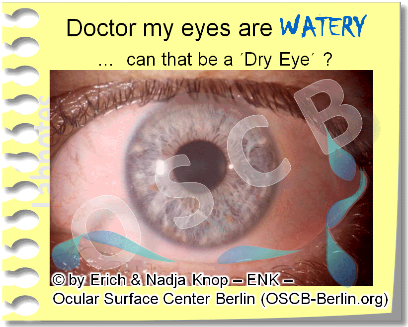 OSCB-Berlin.org_(c)ENK_Trockenes-Auge,-Dry-Eye-Disease,-Contact-Lens,-Kontaktlinse__Doctor-my-eyes-are-WATERY-...-can-that-be-a-Dry-Eye.gif