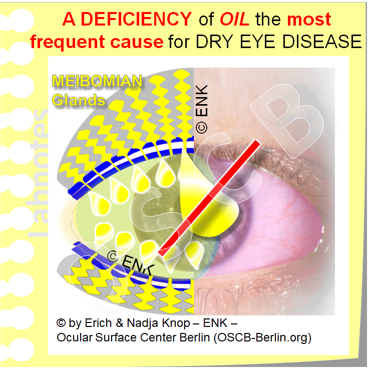 OSCB-Berlin.org_(c)ENK_Trockenes-Auge,-Dry-Eye-Disease,-Contact-Lens,-Kontaktlinse_BASIC-INDICATIONS-FOR-A-SCLERAL-CONTACT-LENS_A-DEFICIENCY-of-OIL-the-most-frequent-cause-for-DRY-EYE-DISEASE.gif