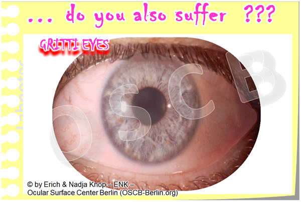 GIF-Animation-TROCKENES-AUGE,-DRY-EYE-SYMPTOME-..DO-YOU-ALSO-SUFFER_600pix-23-2,5_.gif