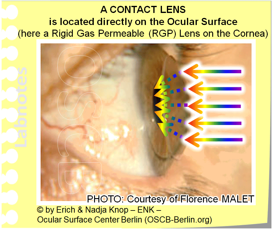 Las lentes de contacto ' rígidas ' son típicamente más pequeñas y se apoyan exclusivamente en la córnea. Necesitan un cierto tiempo de adaptación para el usuario y, por lo tanto, están menos extendidos, pero tienen un material inerte superior y una calidad óptica.