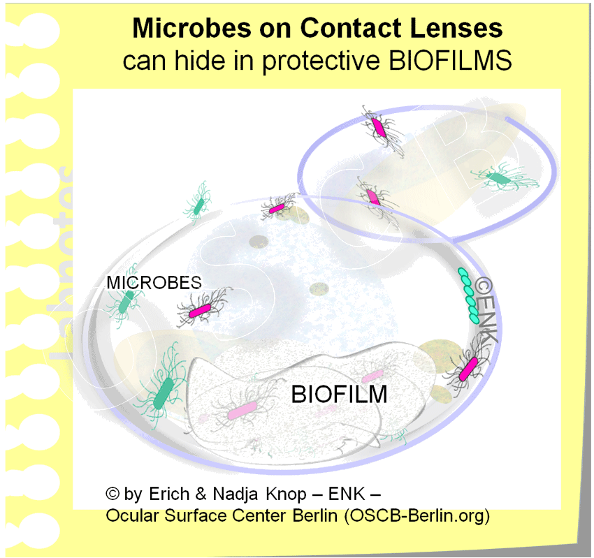 La Higiene Insuficiente es un factor crucial en el uso de la Lentes de Contacto y resulta en una mayor tasa de infecciones oculares en usuarios de lentes de contacto . Los microbios pueden ser introducidos por los dedos del usuario o por el uso de agua del grifo, que debe omitirse. Ciertos tipos de microbios también ocurren en la superficie ocular normal. Los microbios crecen en las lentes y en los contenedores de almacenamiento y forman ' biofilms ' adhesivos que los protegen contra la limpieza y la eliminación.