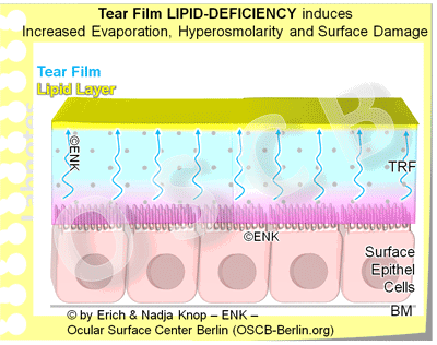ANIMATION_ÖL-MANGEL-im-Tränenfilm-führt-zu-VERDUNSTUNG-etc_Tear Film LIPID-DEFICIENCY_EINZELBILDER,-ENGLISCH_+33-66-,400-40-1_.gif