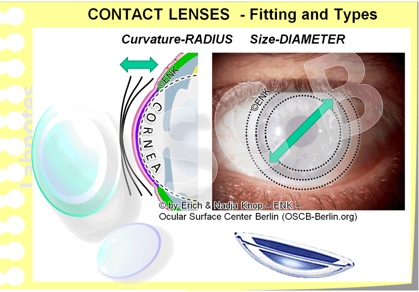 OSCB-Berlin.org_(c)ENK_Trockenes-Auge,-Dry-Eye-Disease,-Contact-Lens,-Kontaktlinse_CONTACT-LENSES---FITTING-and-TYPES_.gif