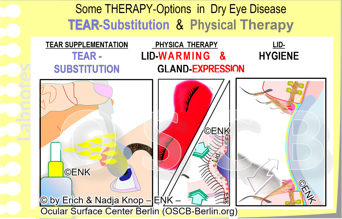 OSCB-Berlin.org_(c)ENK_Trockenes-Auge,-Dry-Eye-Disease,-Contact-Lens,-Kontaktlinse__Some-THERAPY-OPTIONS-in-DRY-EYE-DISEASE_WEB-20_.gif