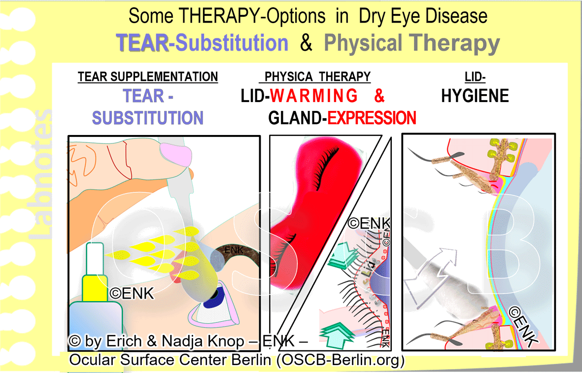 OSCB-Berlin.org_(c)ENK_Trockenes-Auge,-Dry-Eye-Disease,-Contact-Lens,-Kontaktlinse__Some-THERAPY-OPTIONS-in-DRY-EYE-DISEASE_WEB-20_.gif