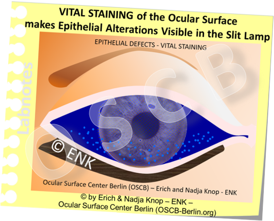 OSCB-Bild_6.0_Dry Eye Disease_DIAGNOSIS_VITAL STAINING of the Ocular Surface makes Epithelial Alterations Visible in the Slit Lamp, FLUOrescense_SCHRÄG.png