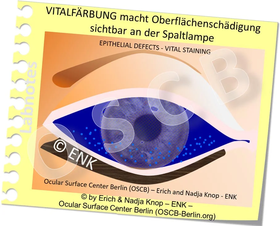 OSCB-Berlin.org_(c)ENK_Trockenes-Auge,-Dry-Eye-Disease,-Contact-Lens,-Kontaktlinse__VITALFÄRBUNG macht Zellschäden sichtbar an der Spaltlampe.jpg