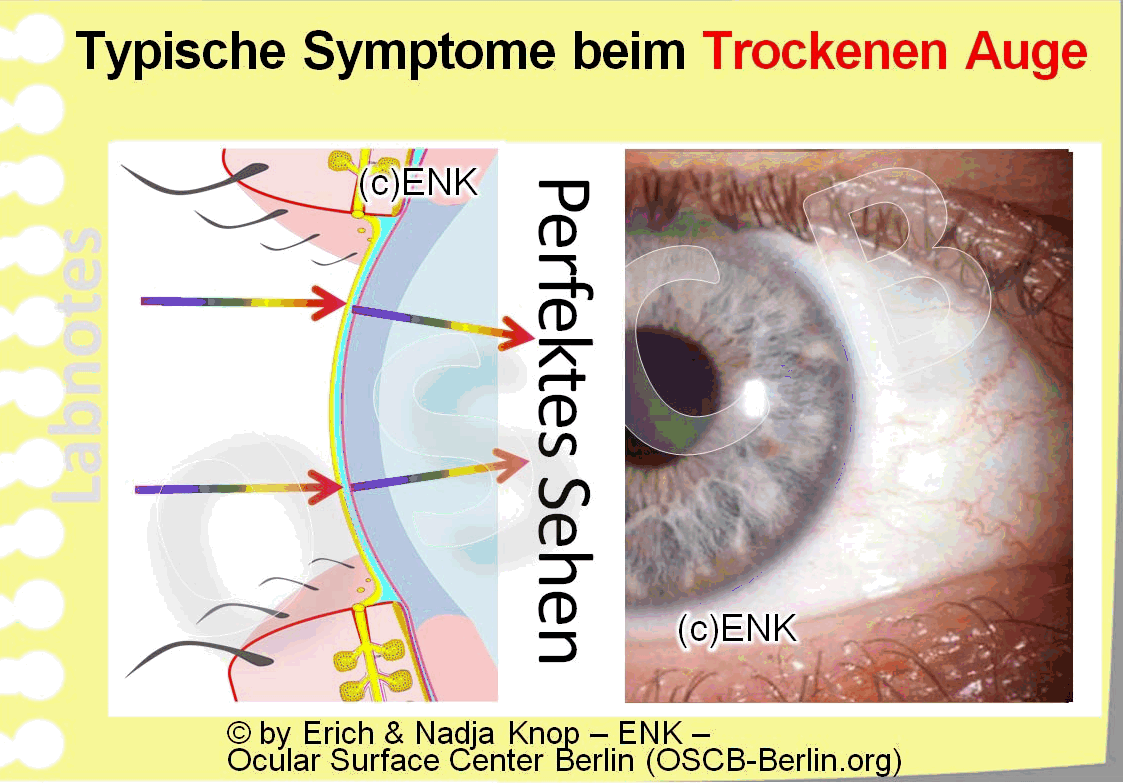 GIF Animation_Typische Symptome beim Trockenen Auge_Bild 4v4_48-72_4-0.5fps_.gif